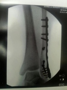 broken ankle -- red haute