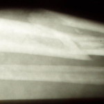 The Risks of Roller Derby